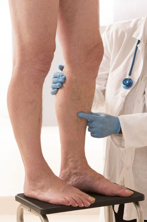 Varicosis Que é