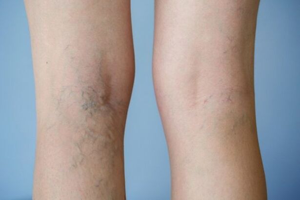 varices
