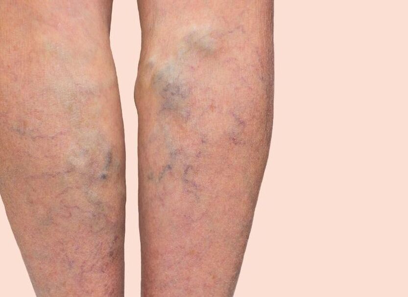 Como son as varices