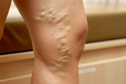 drogas para varices