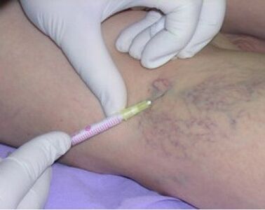 inxeccións para varices